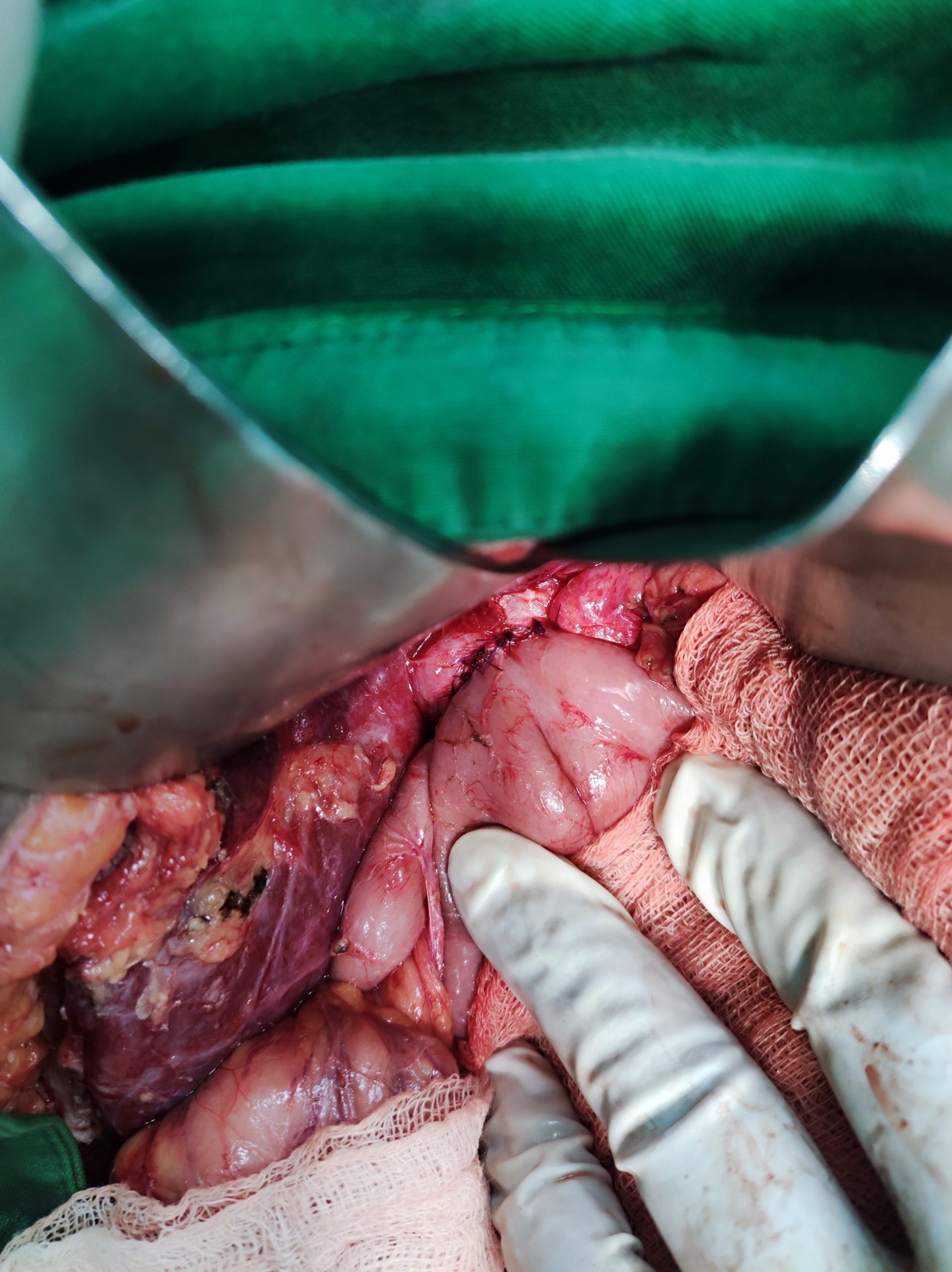 Dr. Murshidul Arefin performing pancreas surgery in Dhaka – pancreatic tumor, cyst, and stone treatment in Bangladesh.