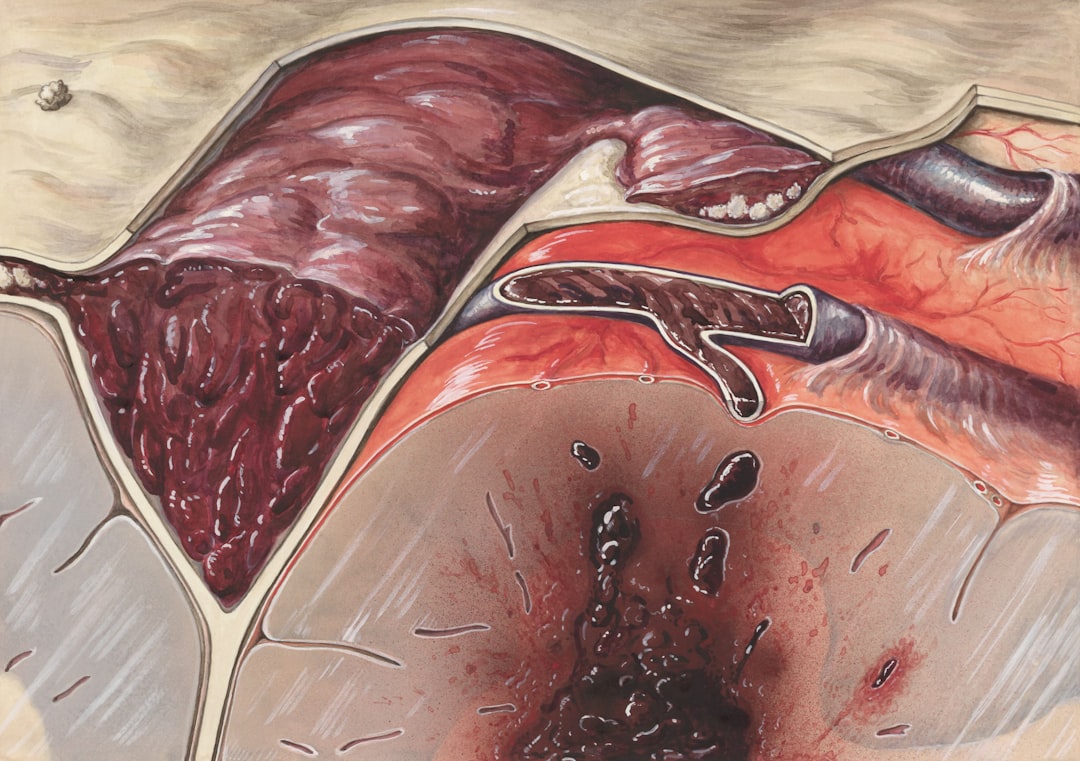 Photo Gallbladder Removal