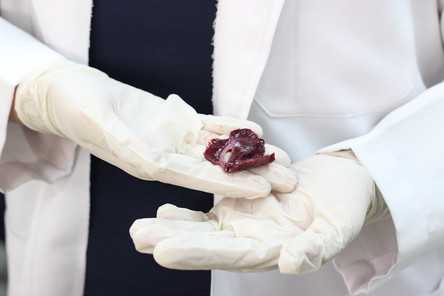 Photo Liver Hemangioma Treatment