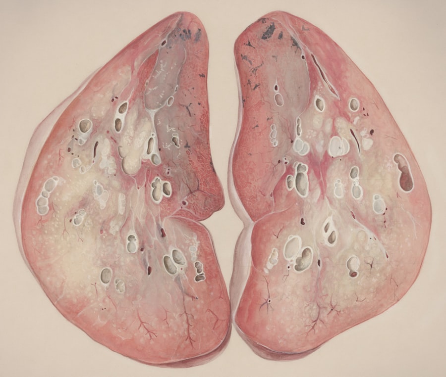 Photo Liver Cyst