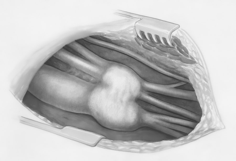 Photo Spleen Rupture
